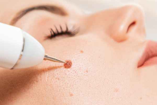CryoPen: 5 Skin Concerns It May Be Used to Treat 3 What actually happens during a CryoPen treatment Midhurst?