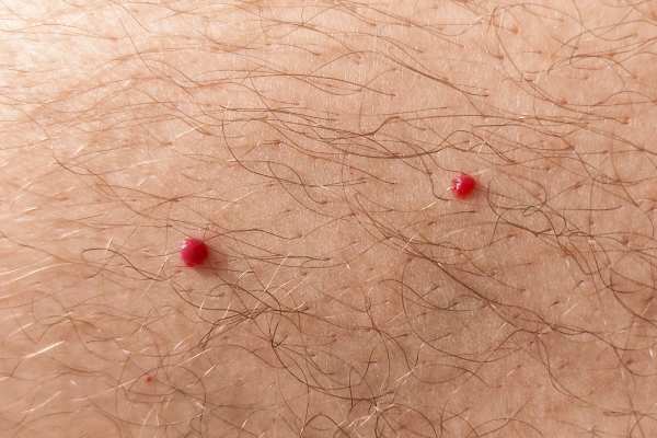 CryoPen: 5 Skin Concerns It May Be Used to Treat 2 cherry angioma removal Midhurst