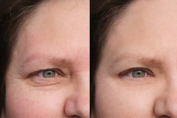 HIFU vs Botulinum Toxin: Understanding the Differences 4 How long do HIFU results last Midhurst?