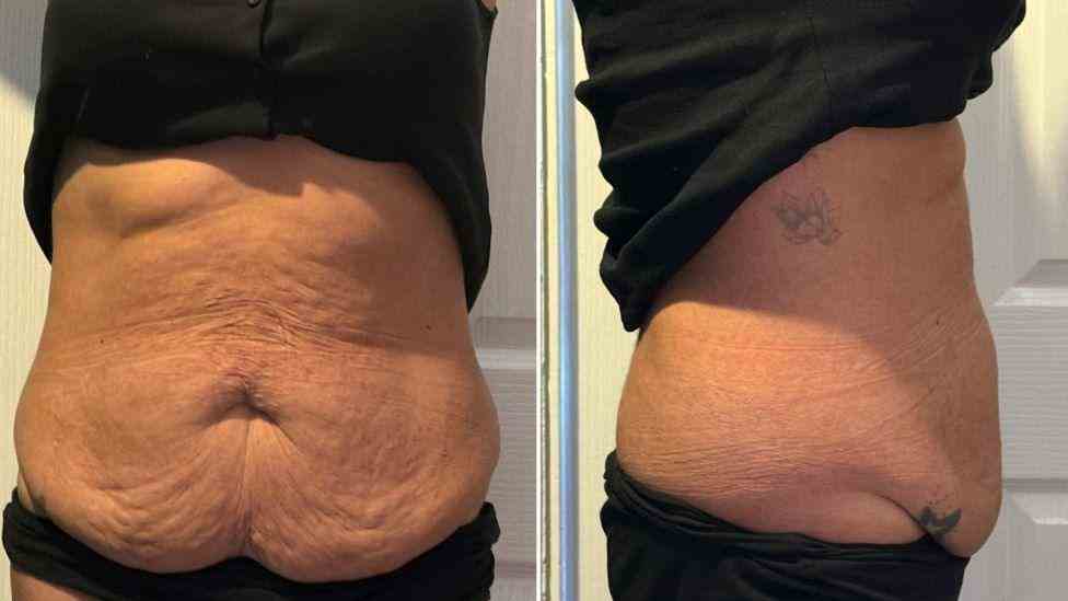 Lost the Weight but Not the Loose Skin? What You Should Know 1 Is It Definitely Loose Skin Midhurst?